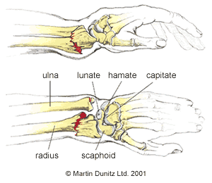 Wrist Fracture Pictures