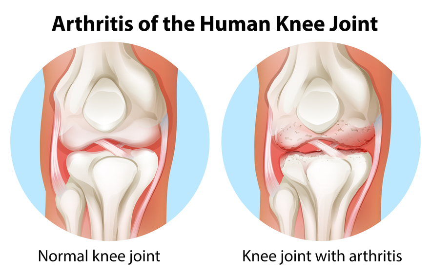 Image result for osteoarthritis knee