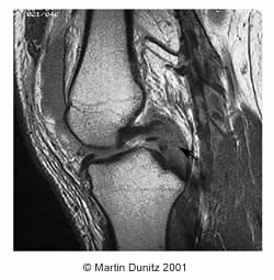 PCL tear xray