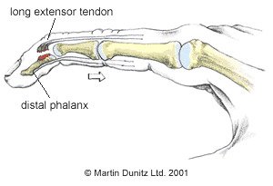 mallet finger