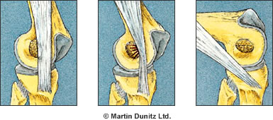 liotibial_band_impingement