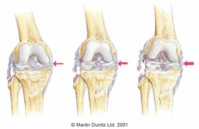 ACL Injury