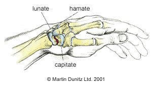 broken-wrist-scaphoid-fracture