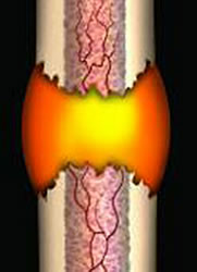 Inflamed bone fracture