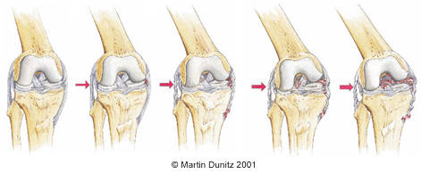 collateral_ligament_1