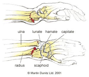 colles fracture broken wirst