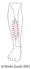 compartment syndrome shin bone