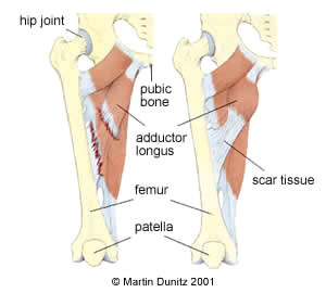 Groin Strain - Groin Muscles 