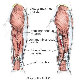 Hamstring Muscle Strain