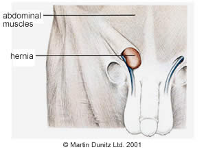 Inguinal Hernia