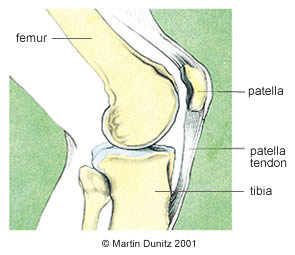 Patellofemoral Pain Syndrome