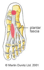 Plantar fasciitis