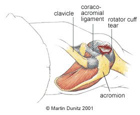 Rotator Cuff Calcific Tendonitis