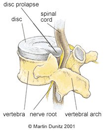 Sciatica 