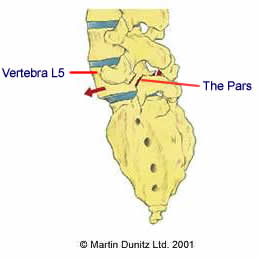 Vertebra L5 and the pars