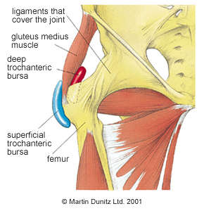 Hip Bursitis 