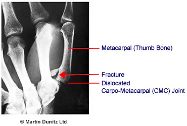 Anatomy of a Bennett's Fracture injury