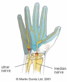 Anatomy of carpal tunnel syndrome in the wrist