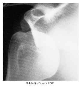 x-ray of dislocated shoulder