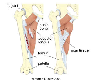 Anatomy of a groin strain injury