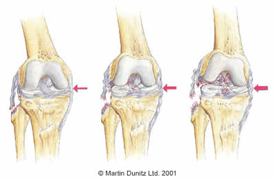 Anatomy of Lateral Collateral Ligament injury