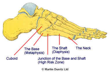 anatomy of the metatarsal bones