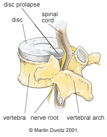 Anatomy of herniated disc