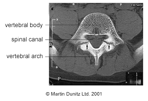 CT scan of spondylolysis