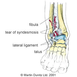 High ankle sprain Anatomy of ankle sprain injury