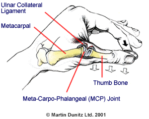 Anatomy of a thumb sprain injury