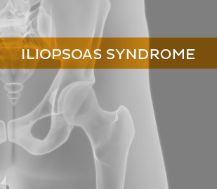IlioPsoas Syndrome