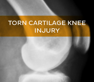 Torn Cartilage Knee Injury