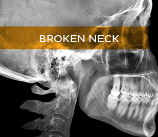 Broken Neck