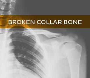 Broken Collar Bone