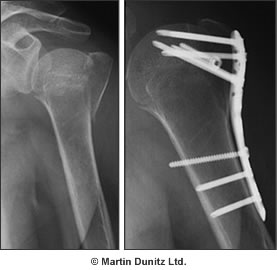 Broken Arm X-Ray