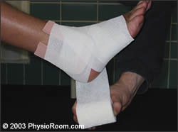 compression strapping a n acutely sprained ankle