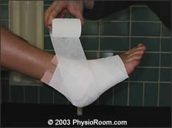 compression strapping a n acutely sprained ankle