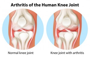 Arthritis of the human knee joint