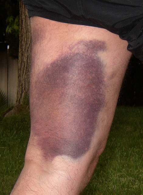Third degree hamstring injuries not only feel bad, but don't look all that good either - Image by Mike Mueller (Flickr CC)