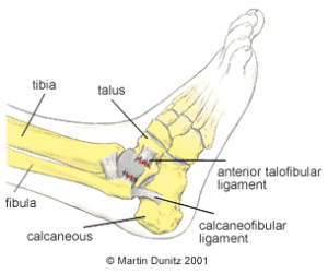 Ankle Ligament Damage