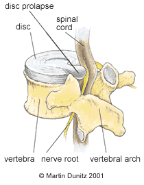 Lower Back Pain