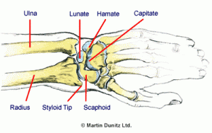 Wrist Arthritis