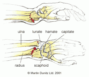 Colles Fracture