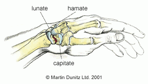 Scaphoid Fracture